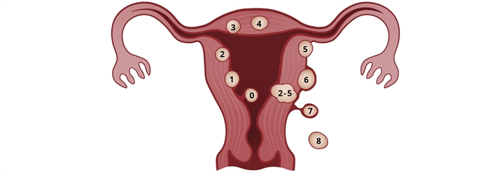 Fibromer i uterus