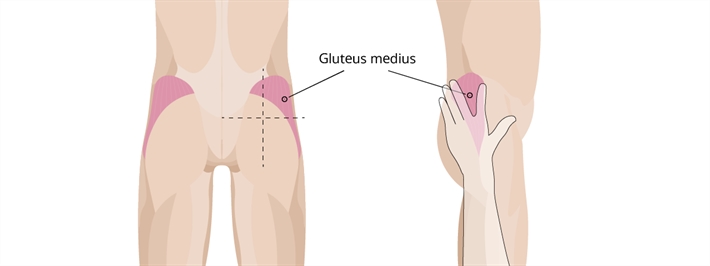 I.m gluteus medius 2024