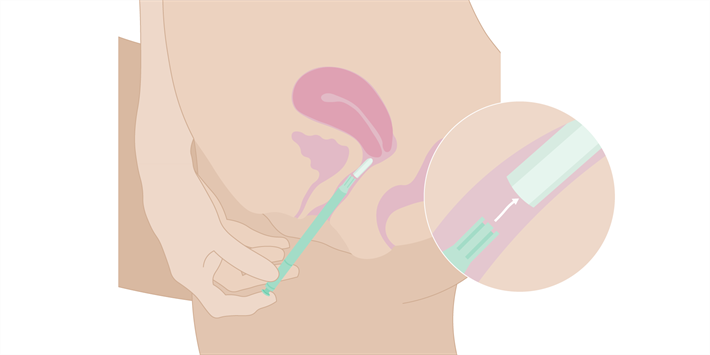 Medicin-som-bruges-i-skeden_applikator-vagitorie_v01_2025.02.14.png